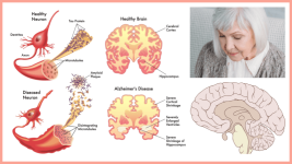 Alzheimer's disease