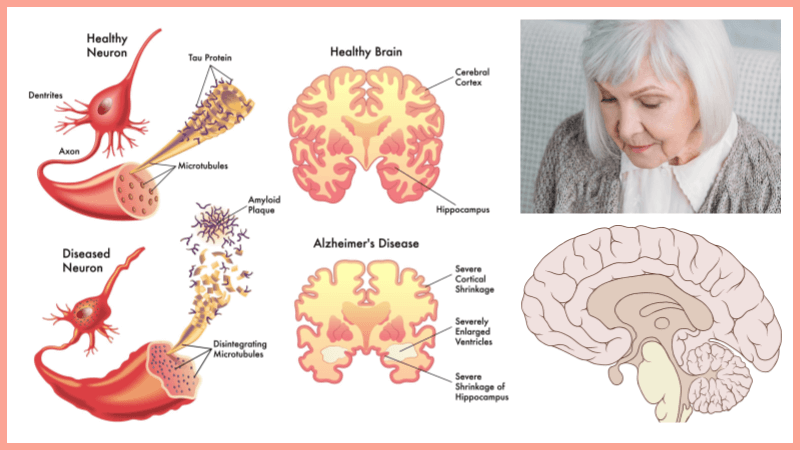 Fading Memories – A Case Study on Alzheimer’s Disease