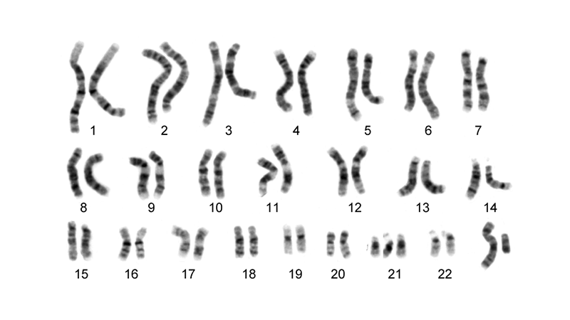nondisjunction karyotype